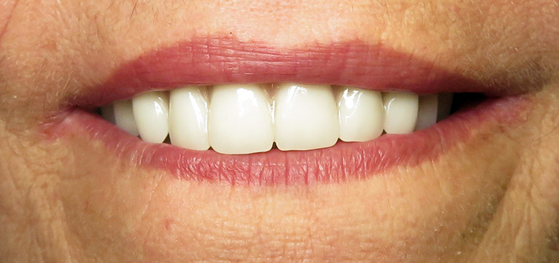 Oceanview Dental patient close up after All-on-4