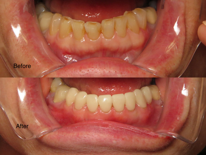 Dental before and after