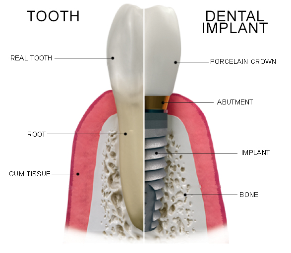 dental implant illustration showing the various parts